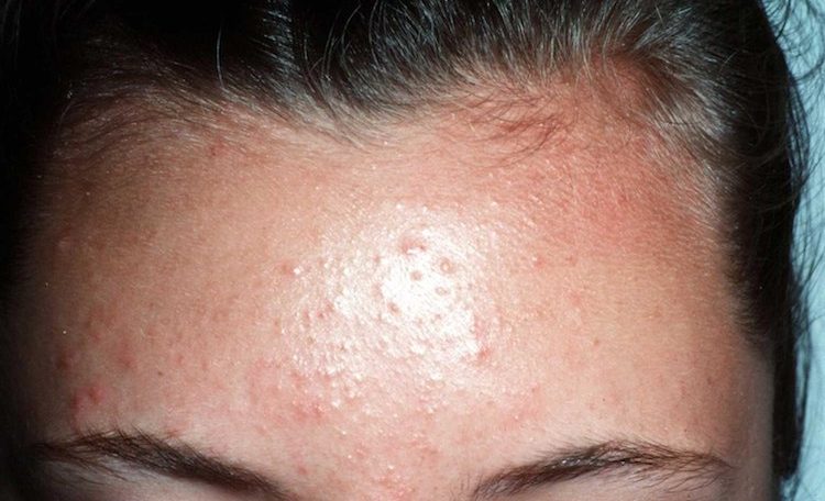 fungal acne